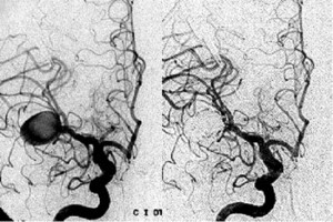 angiografia_cerebral