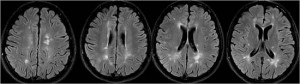 resonancia_magnetica_cerebral